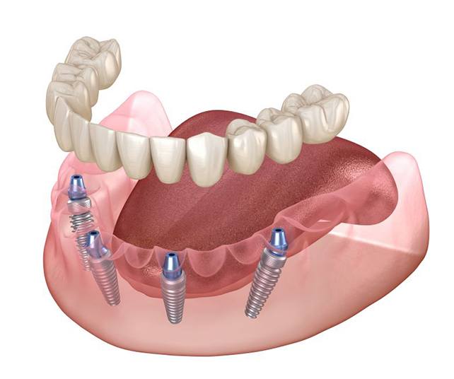 Illustration showing All-on-4 dental implants against white background