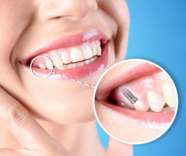 Woman’s smile with a single dental implant