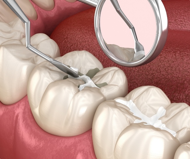 Animated smile during dental sealant placement