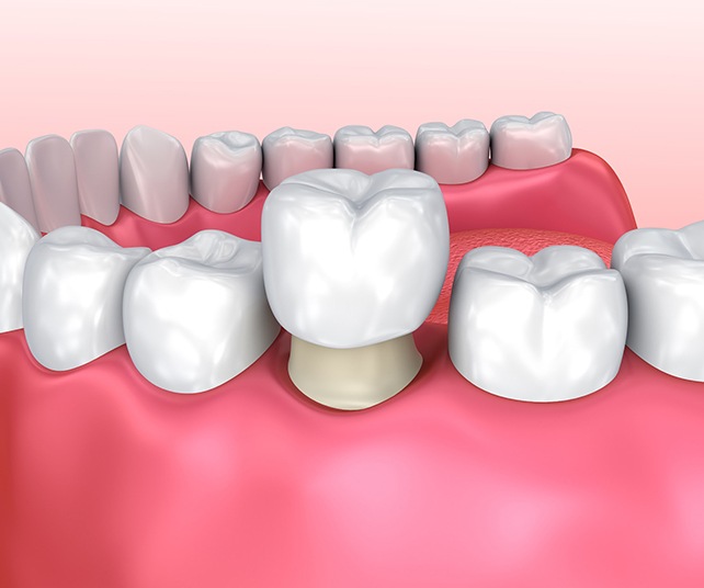 Dental crown over reshaped tooth