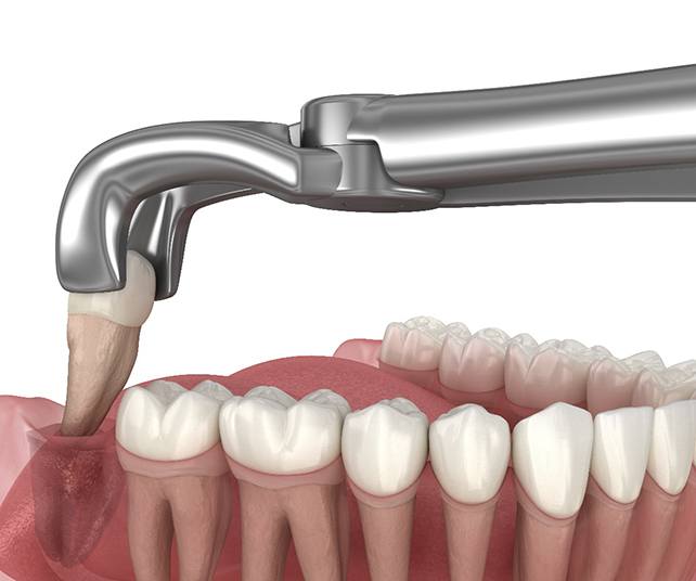Illustration of a tooth being extracted