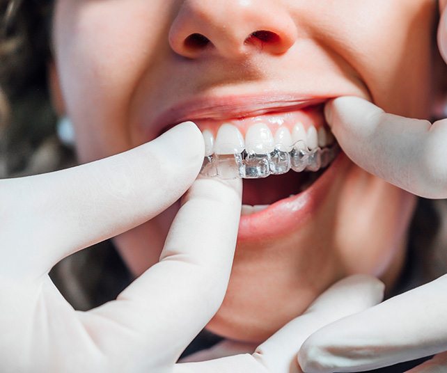 Dentist putting clear aligner on patient