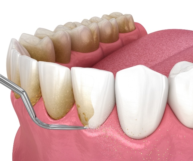 Animated smile during scaling and root planing gum disease treatment