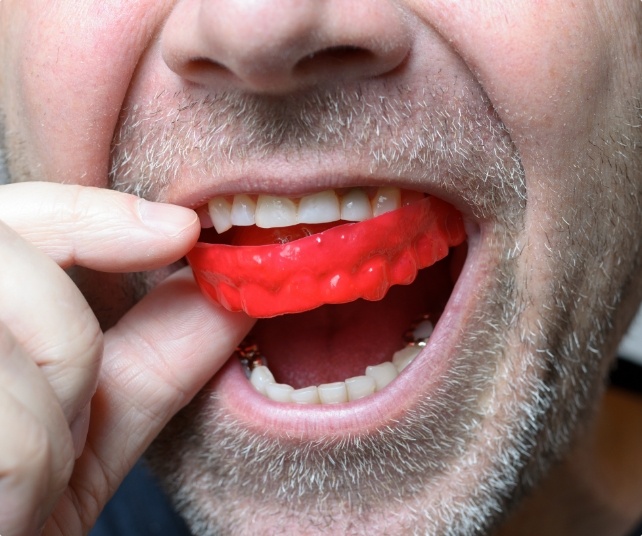 Closeup of patient placing nightguard for bruxism