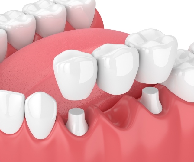 Animated smile during dental bridge placement