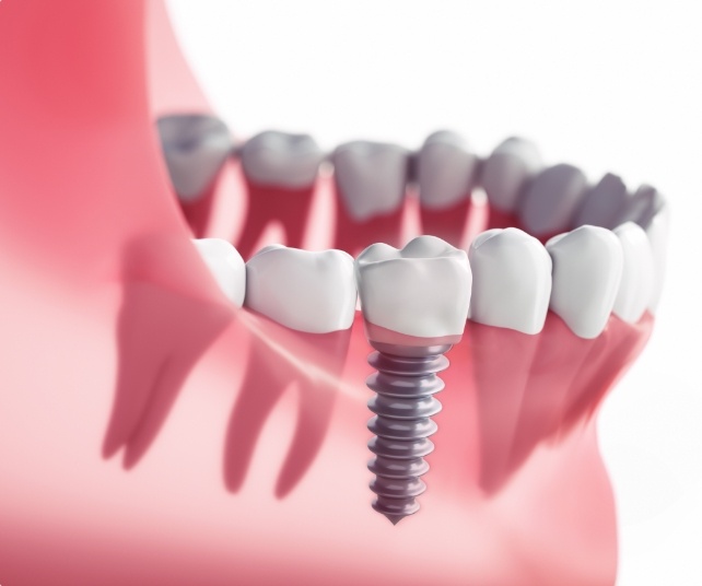 Animated smile with dental implant supported dental crown