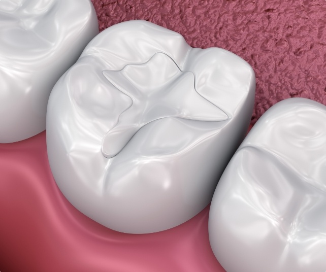 Animated smile with tooth colored filling restorative dentistry treatment