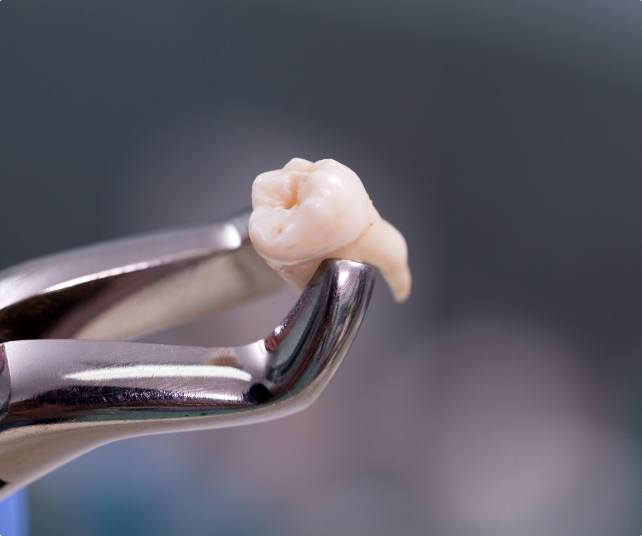 Metal clasp holding an extracted tooth