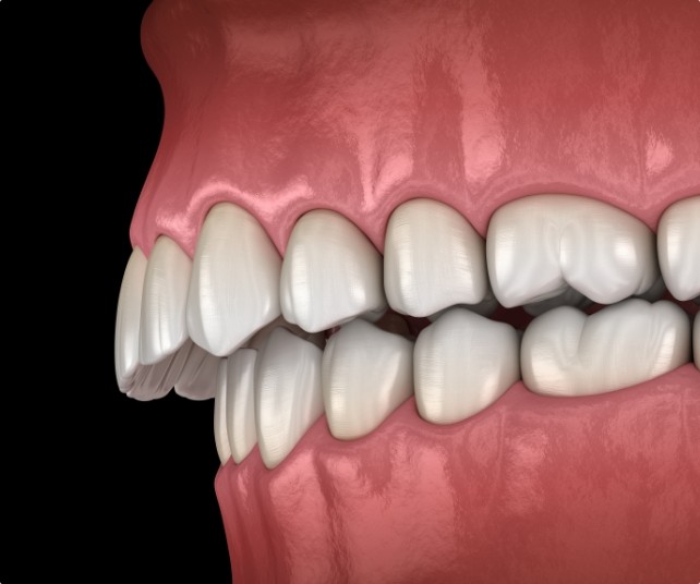 Animated smile misaligned before equilibration and occlusal adjustment