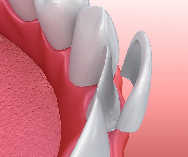 Illustration of veneer being placed on front tooth