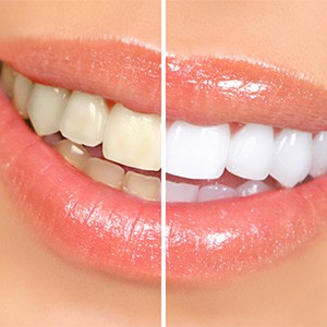 Closeup of a smile with sparkly gloss that’s halved to show effects of teeth whitening