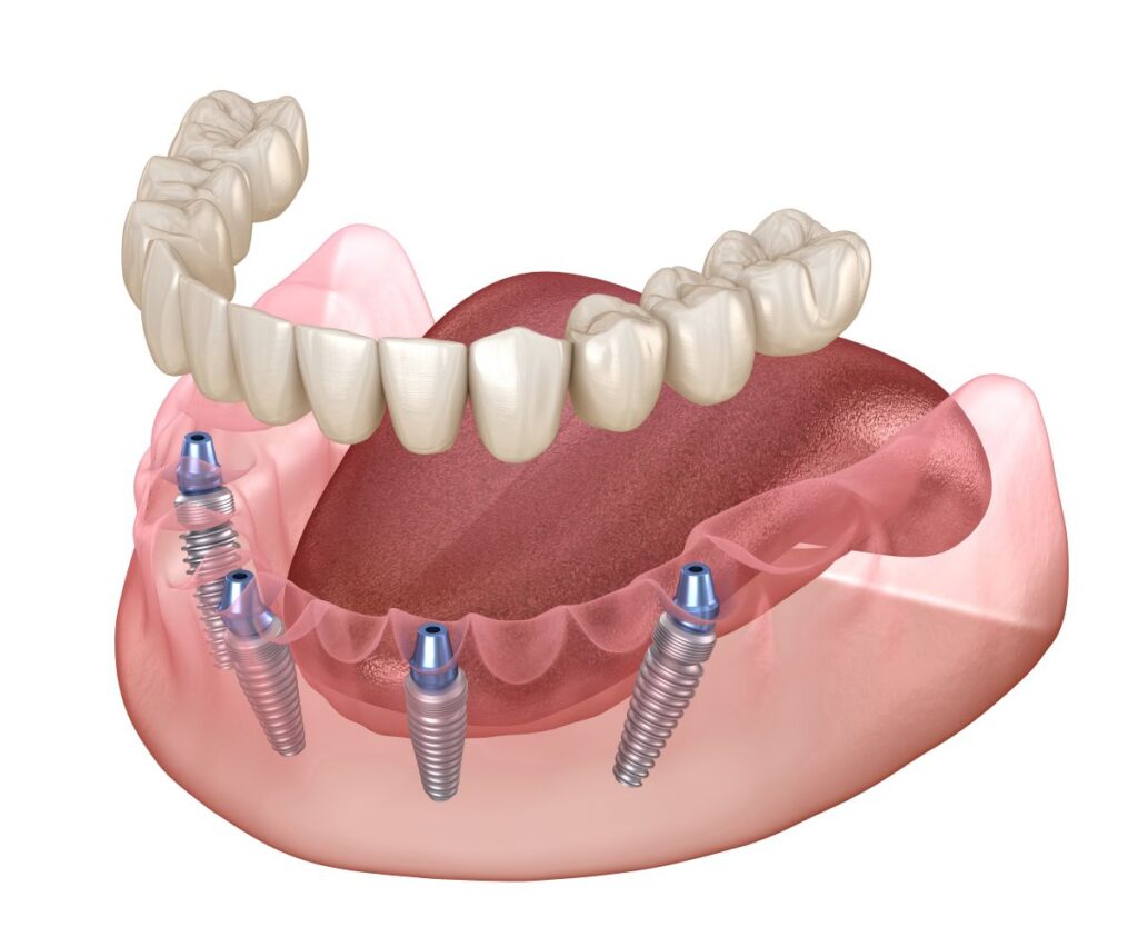 A CGI image of All-on-4 dental implants.