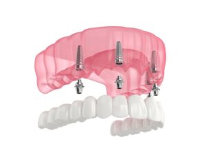 Rendering of All-on-4 implants.